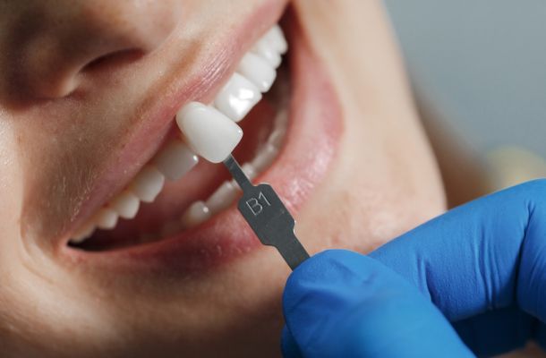 Estética Dental