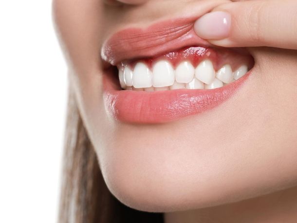 Periodoncia