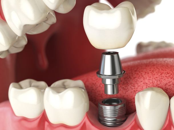 Implantología Dental