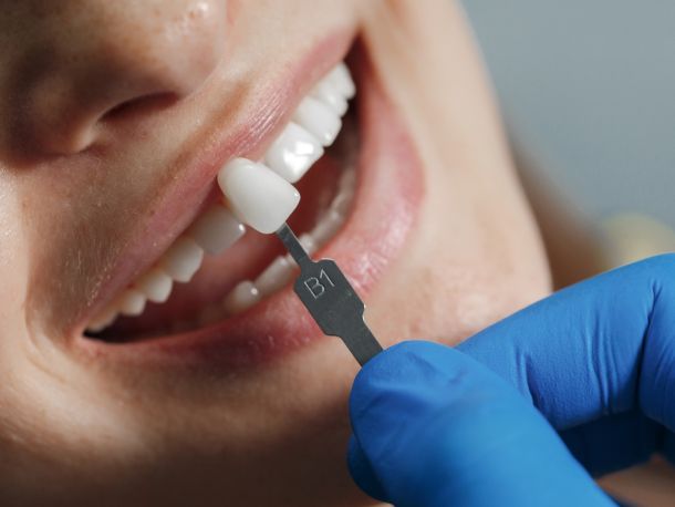 Estética Dental