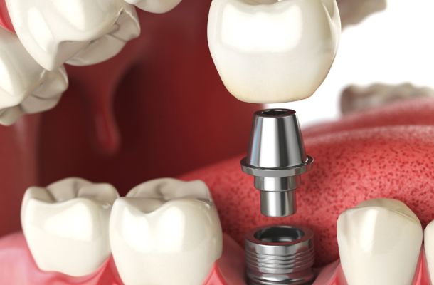 Implantología Dental